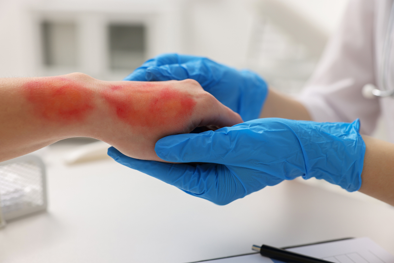 Doctor checking patient burned hand