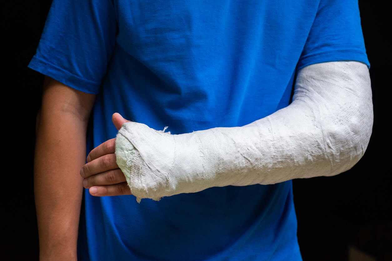 Person with a full arm cast, symbolizing a catastrophic injury sustained from unsafe property conditions, relevant to Virginia premises liability cases.